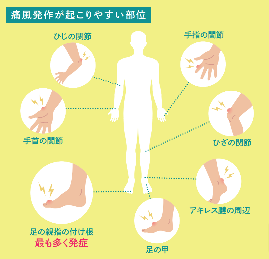 痛風（高尿酸血症）